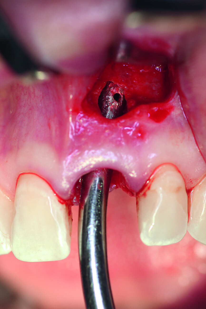 Fig. 3: After the extraction, the apical granulation tissue was excochleated.