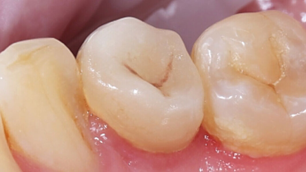 Fig. 14. Resultado: integración altamente estética de la restauración durante la revisión al cabo de seis meses.