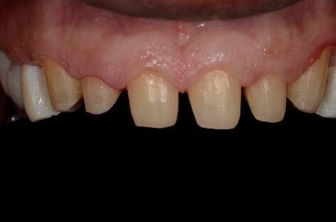 Fig 3: Knife edged margins for lithium disilicate crowns
