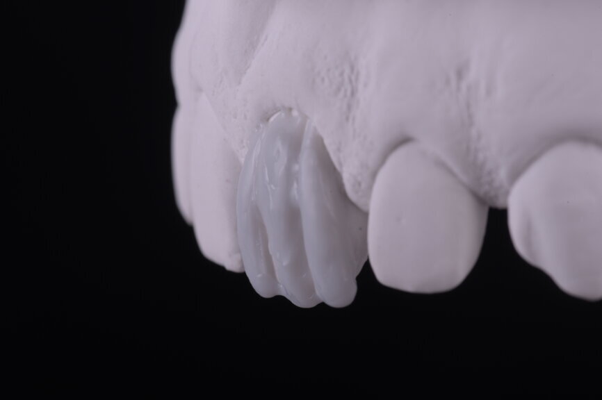 Fig. 22: First wax-up unit, lateral view.