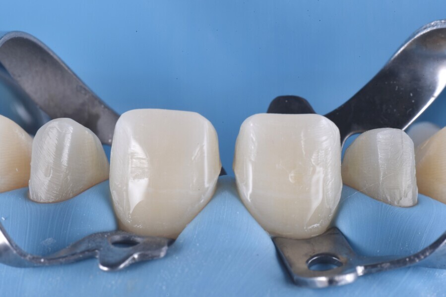 Figs. 15a & b: Adhesive procedures.