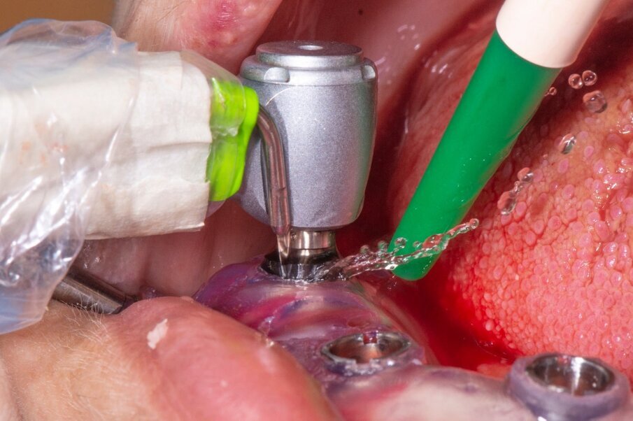 Fig. 9_Preparatore crestale.