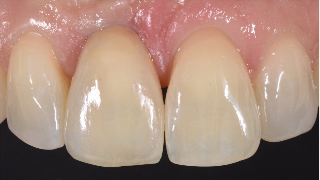Digital dental shade measurement: Practical applications with a state-of-the-art colorimeter