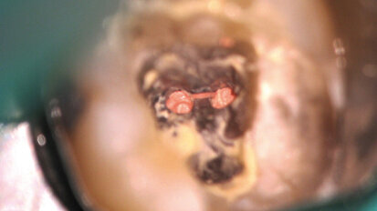 Le traitement d’une molaire mandibulaire calcifiée : un protocole des temps modernes