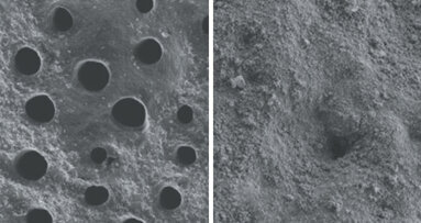 Hloubková obnova skloviny – zmírnění citlivosti zubu již po 1. použití, klinicky prokázáno