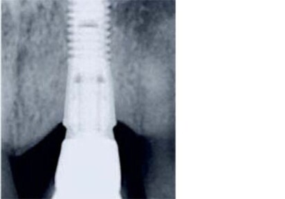 New, five-year data confirm maintained bone levels and biological sustainability with OsseoSpeed implants