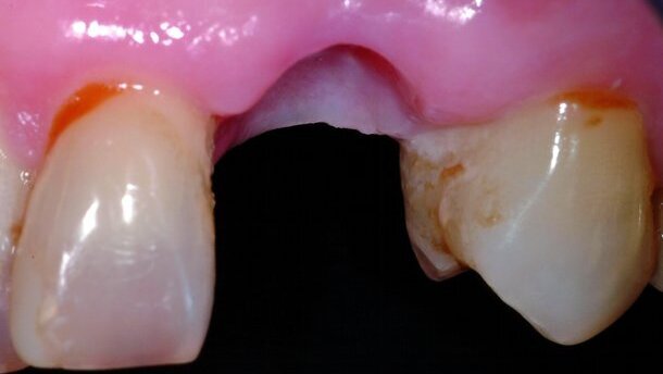 Préservation de la crête alvéolaire après extraction