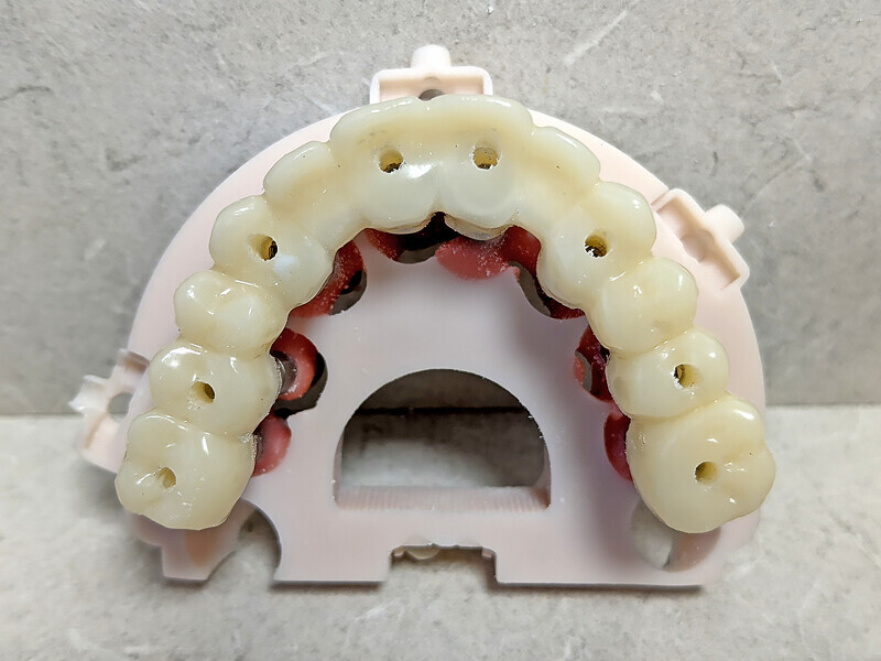 Fig. 14b: Retracted view of the provisional restorations (a) fabricated with C2F small hole technology (b). Two-week post-op smile (c). Two-week post-op panoramic radiograph and intra-oral photograph showing excellent healing (d & e).