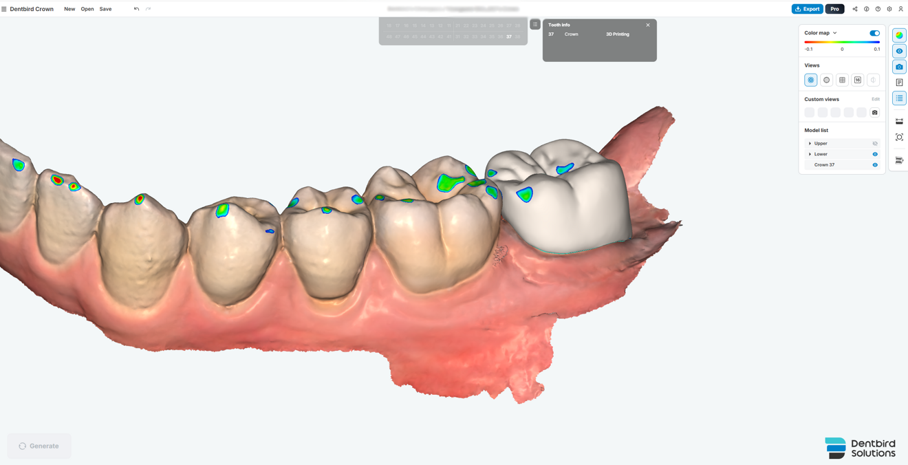 Fig. 6d: Oblique view demonstrating the crown’s integration within the overall occlusal scheme.