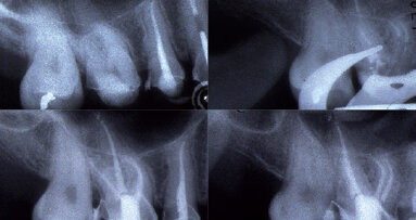 Vhodná technika vypracování apikální části kořenového kanálku