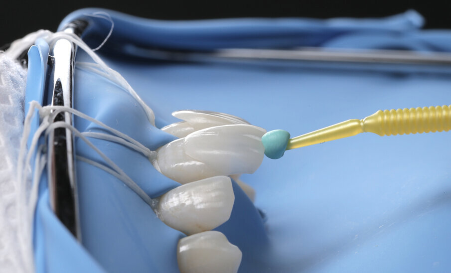 Fig. 10: Inserting the veneers using rubber dam for perfectly dry luting surface.