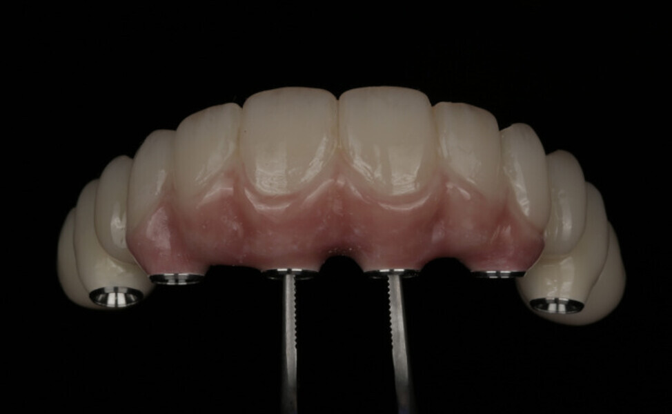 Fig. 19a: Prototype with new design to improve aesthetics. FP-3 in the anterior.