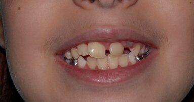 An Unerupted Maxillary Permanent Central Incisor and its Multi-Faceted Management