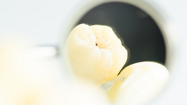 Können Probiotika ECC bremsen?