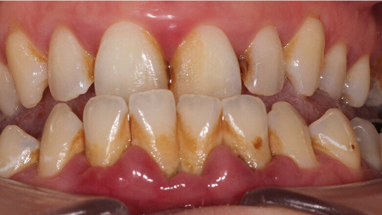 Plaque bacteria prove no match for guided biofilm therapy