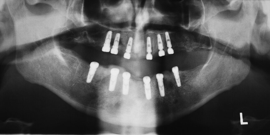 Fig. 20 : Tomographie panoramique dentaire du patient aux fins du contrôle du résultat final.