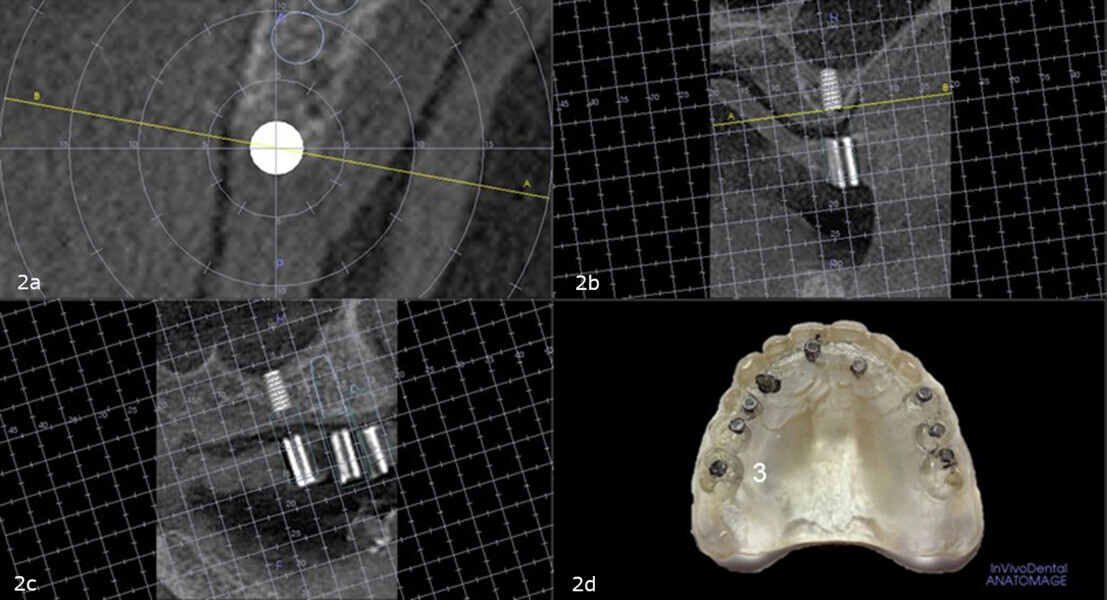 Figs. 2a–d: Virtual planning with the diagnostic guide placed intra-orally during the CBCT scan showing insufficient crestal height in the maxillary right first molar site to allow implant placement without a crestal sinus lift (a–c). Site on the duplicate denture (d).
