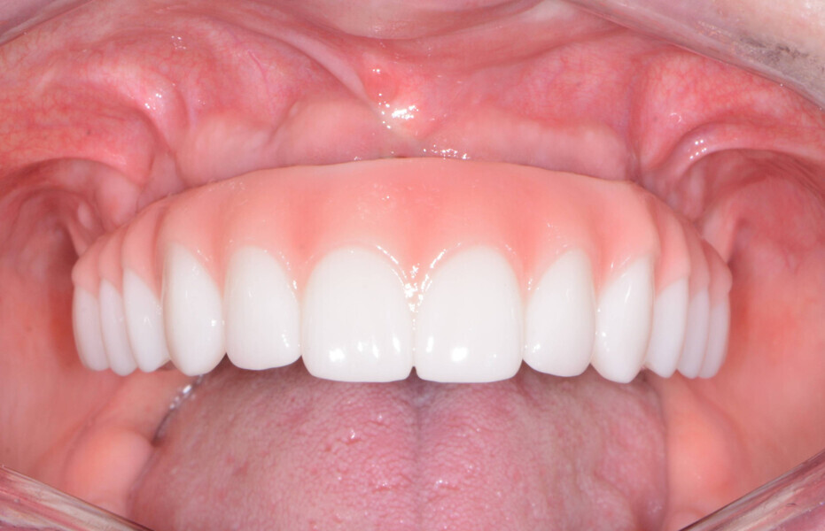 Fig. 17: Post-op retracted frontal view.