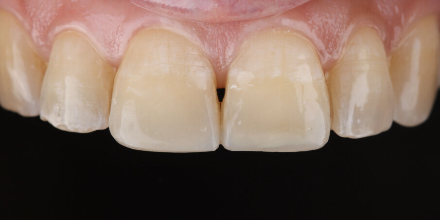 Fig 16. Two-week post op