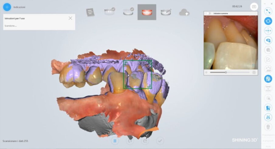 Figg. 13, 14_File STL ottenuti tramite scanner intraorale.