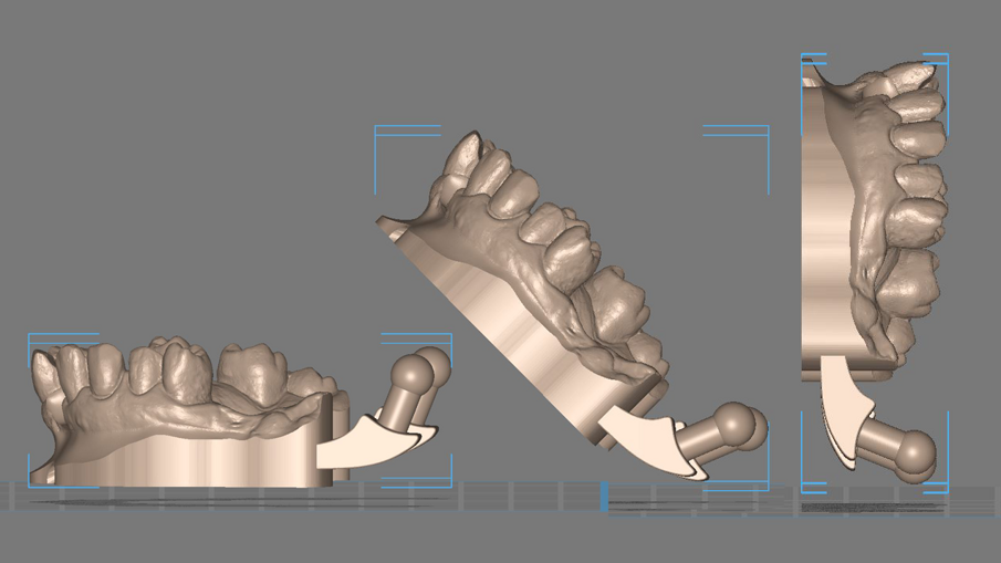 Figg. 8, 9_L’orientamento dei modelli o degli oggetti da stampare influenzerà l’ingombro, la velocità e il tipo di supporti e la quantità di essi. Pochi supporti potrebbero creare aree di cedimento, troppi supporti creerebbero aree di imperfezione, orientare una corona con il bordo incisale in alto creerà dettaglio sul bordo stesso riducendo la precisione del dettaglio con l’Interface/Ti-Base, il contrario permetterà di avere tanta precisione sull’interfaccia con l’abutment ma meno su bordo incisale. 