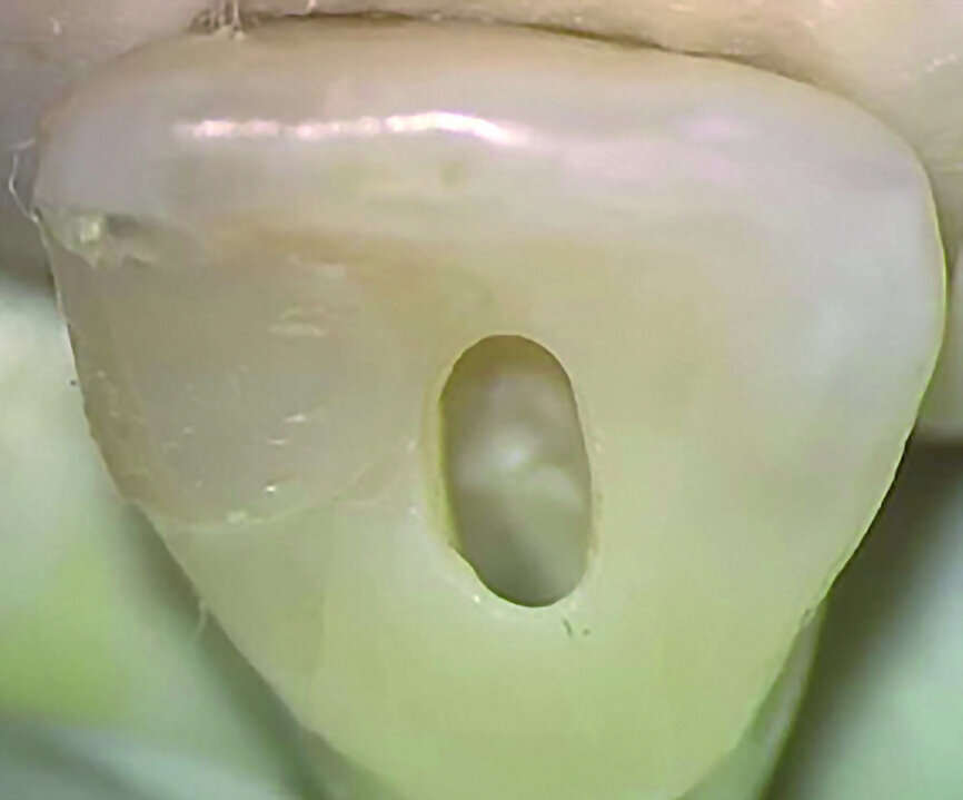 Fig. 1 : Incisive centrale supérieure avec cavité d’accès ovale allongée préparée près du bord incisif, suffisamment sous le cingulum, de faible largeur dans la dimension mésio-distale. (Photos : fournies par le Dr L. Stephen Buchanan, sauf indication contraire) 