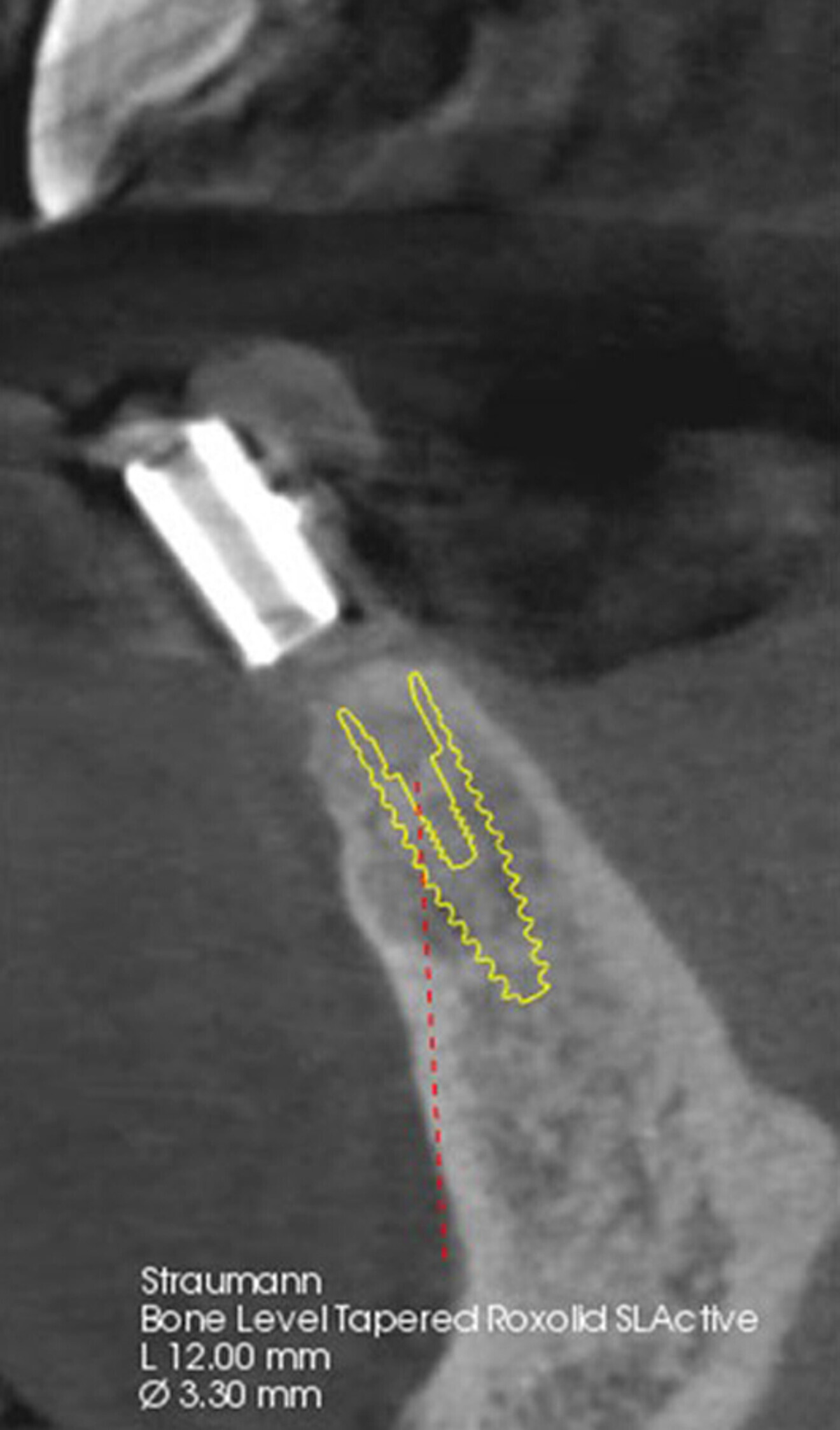 Fig. 8: Cross-sectional view of the planned implant site with the diagnostic guide in place and the virtual planned implant in the ideal position relative to the anatomy. 