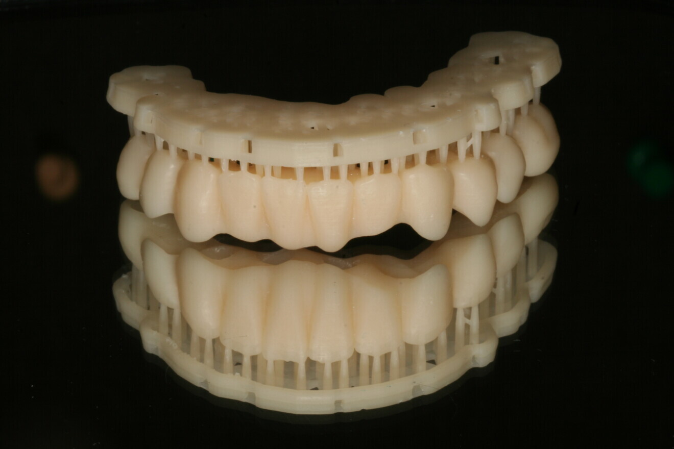 Fig. 8: 3D-printed temporary restoration.