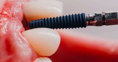 Mais de 10.000 implantes dentários colocados usando o sistema robótico Yomi