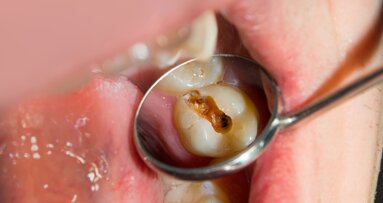 Could zinc make cavity treatment simpler, painless and drill-free?