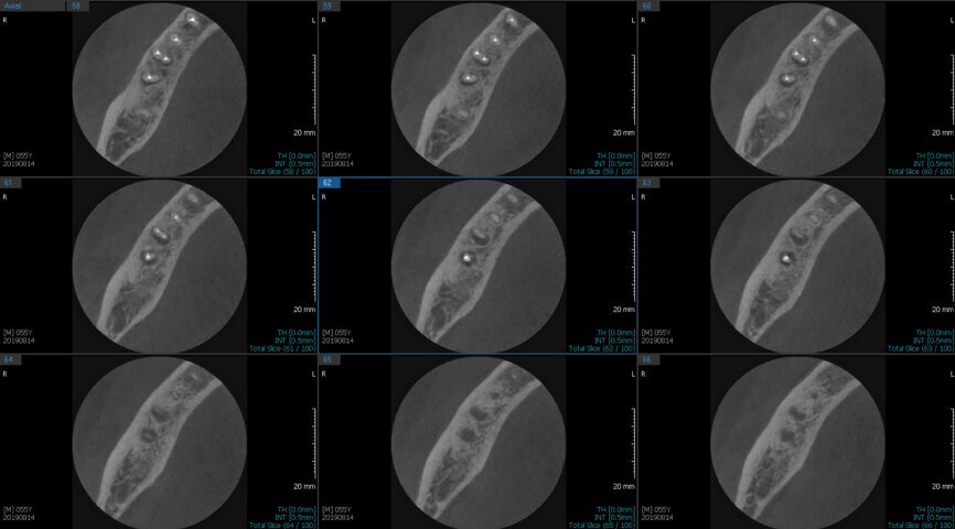 Fig. 6c: Post-op CBCT images of tooth #46 showing adequately obturated canals at all levels to the working length and sealing of the furcation defect.