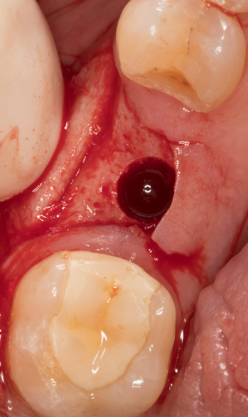 Ryc. 12_Łoże pod implant.