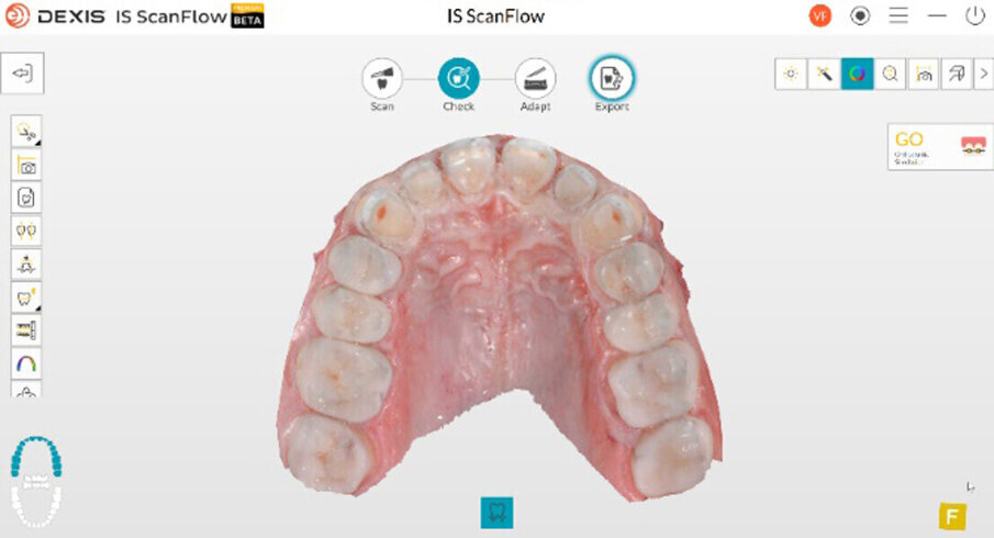 Obr. 11a a b: Digitální otisky předních čelistních korunek.
