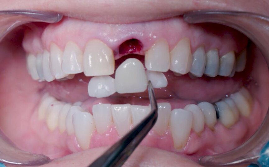 Fig. 22: Fitting assessment of provisional tooth shell.