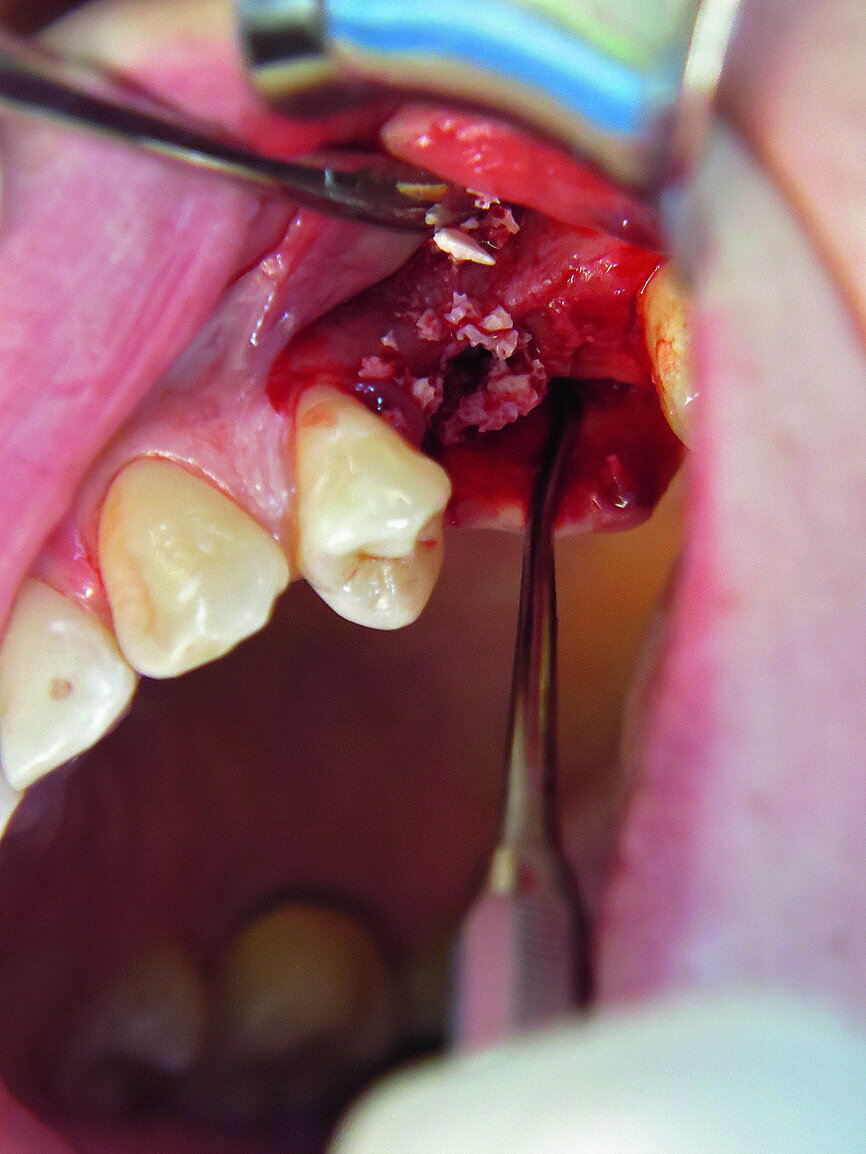 Fig. 16: Augmentation and sinus elevation.