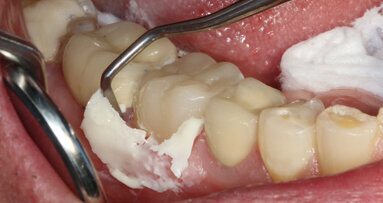 Benefits of bonding meet the simplicity of traditional cementing