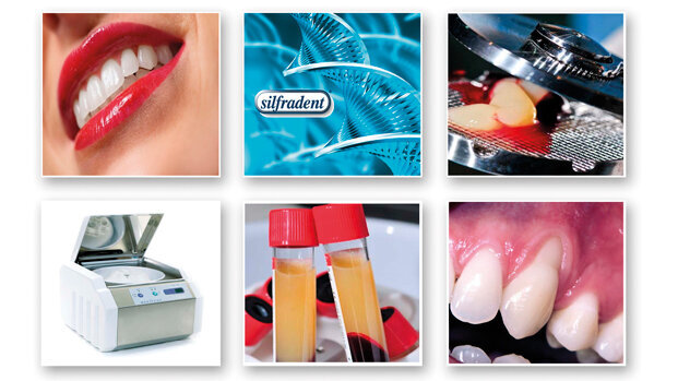 Concentrato di fattori di crescita  (Concentrated Growth Factors – CGF): un importante strumento nella medicina rigenerativa