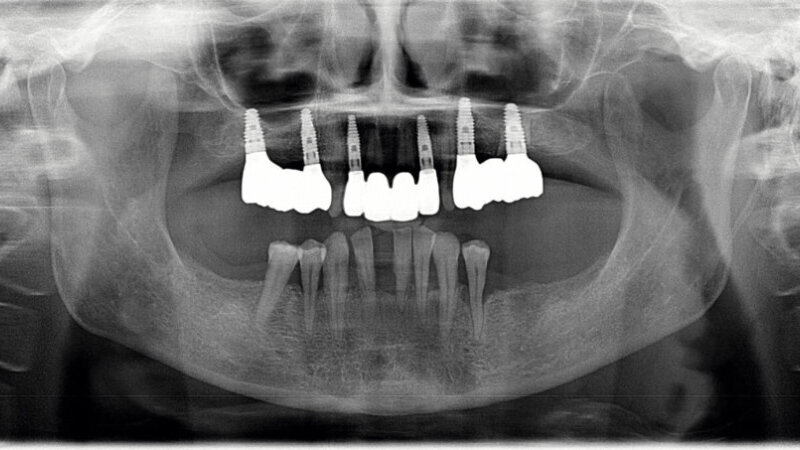 Augmentacija dentinskim graftom u gornjoj čeljusti