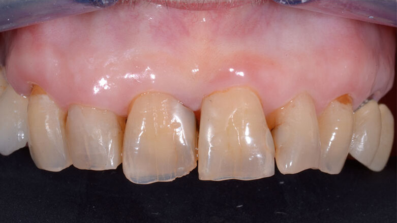 Posizionamento di impianto post-estrattivo a protesizzazione immediata in area estetica mascellare