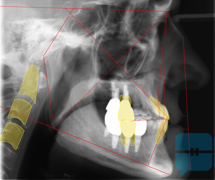Figs. 31a & b: Final lateral cephalometric radiographs.