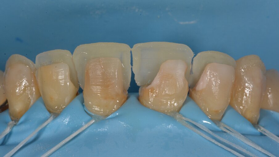 Het resultaat na voorzichtig wegnemen van de palatale putty.