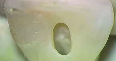 Cutting endodontic access cavities— for long-term outcomes