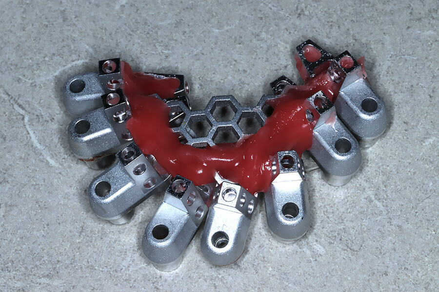 Fig. 5f: OptiSplint after intra-oral luting.