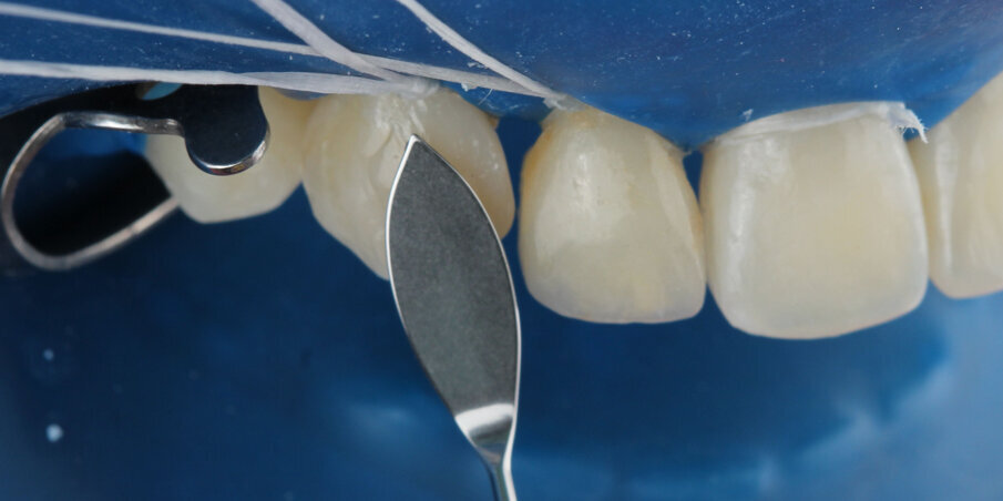 Fig 1: Perfect for shaping the buccal surface of canines