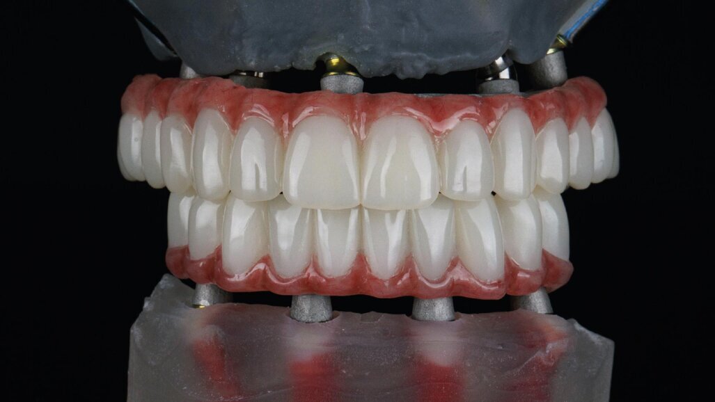 Ridefinire la riabilitazione full-arch: la rivoluzione del workflow digitale nell’implantologia