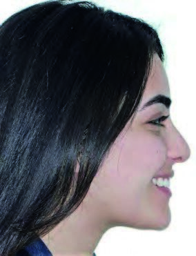 Smile after treatment