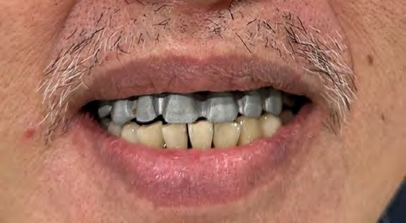 Fig. 2c: Extraoral smile assessment performed during the prosthodontic phase to evaluate smile line, lip support, and aesthetics. 