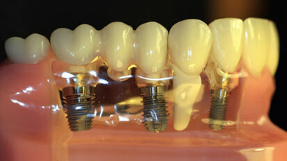 Η αποτυχία των εμφυτευμάτων μπορεί να σχετίζεται με τη χρήση διφωσφονικών