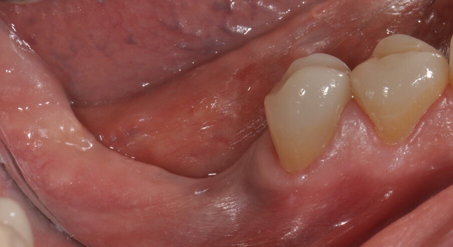 Figg. 1, 2_L’immagine clinica preoperatoria pone in evidenza un ampio difetto osseo sia orizzontale che verticale.