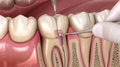 US study examines endodontic prescribing patterns to inform antibiotic stewardship